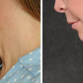 Ponytail Facelift before and after, case 58, view 7 (progress)