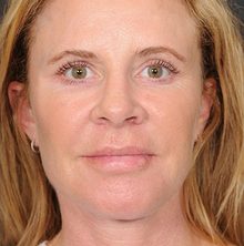 Ponytail Facelift before and after, case 59 (after)
