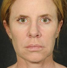 Ponytail Facelift before and after, case 59 (before)