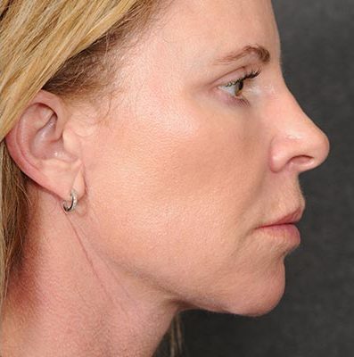 Ponytail Facelift before and after, case 59, view 3 (after)