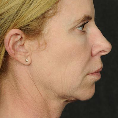 Ponytail Facelift before and after, case 59, view 3 (before)