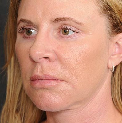 Ponytail Facelift before and after, case 59, view 4 (after)
