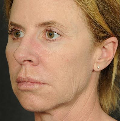 Ponytail Facelift before and after, case 59, view 4 (before)