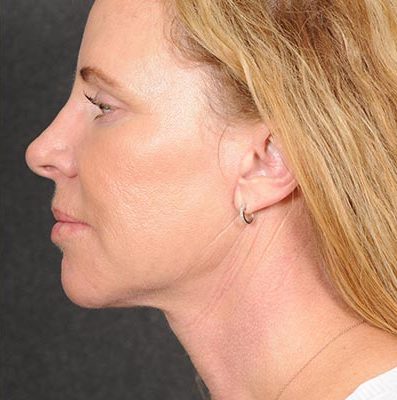Ponytail Facelift before and after, case 59, view 5 (after)