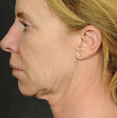 Ponytail Facelift before and after, case 59, view 5 (before)