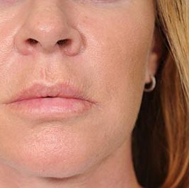 Ponytail Facelift before and after, case 59, view 6 (after)