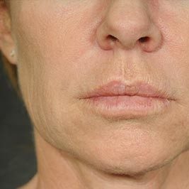 Ponytail Facelift before and after, case 59, view 6 (before)
