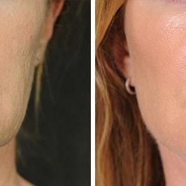 Ponytail Facelift before and after, case 59, view 6 (progress)