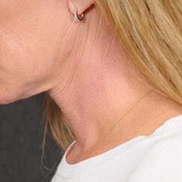 Ponytail Facelift before and after, case 59, view 7 (after)