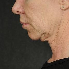 Ponytail Facelift before and after, case 59, view 7 (before)