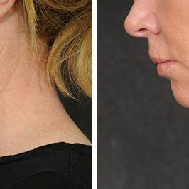 Ponytail Facelift before and after, case 59, view 7 (progress)