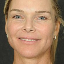 Ponytail Facelift before and after, case 60 (after)