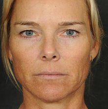 Ponytail Facelift before and after, case 60 (before)
