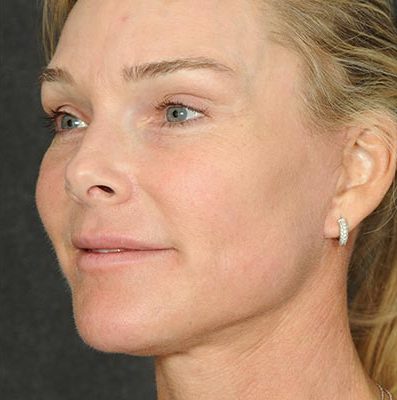 Ponytail Facelift before and after, case 60, view 3 (after)