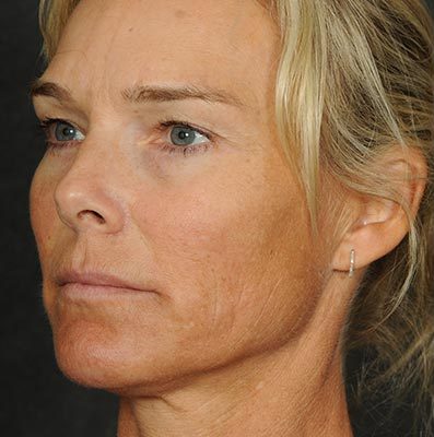 Ponytail Facelift before and after, case 60, view 3 (before)