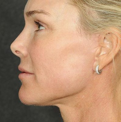Ponytail Facelift before and after, case 60, view 4 (after)