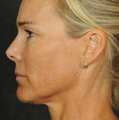 Ponytail Facelift before and after, case 60, view 4 (before)