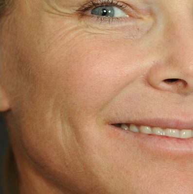 Ponytail Facelift before and after, case 60, view 5 (after)