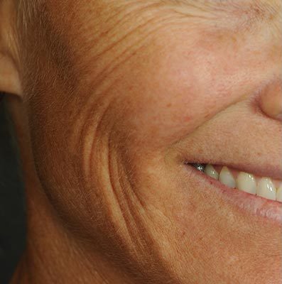 Ponytail Facelift before and after, case 60, view 5 (before)