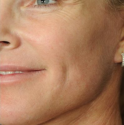 Ponytail Facelift before and after, case 60, view 6 (after)