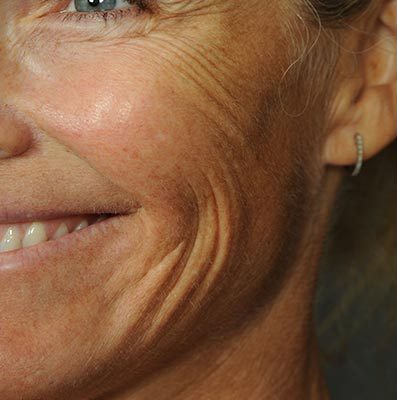 Ponytail Facelift before and after, case 60, view 6 (before)