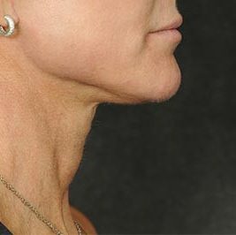 Ponytail Facelift before and after, case 60, view 7 (after)