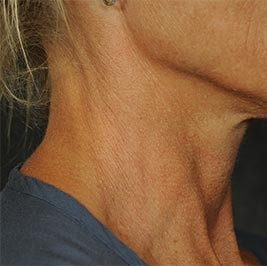 Ponytail Facelift before and after, case 60, view 7 (before)