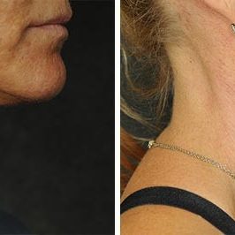 Ponytail Facelift before and after, case 60, view 7 (progress)
