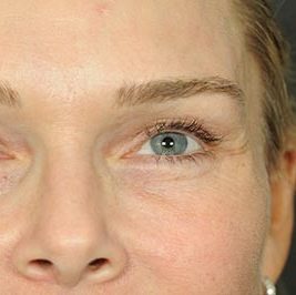 Ponytail Facelift before and after, case 60, view 8 (after)