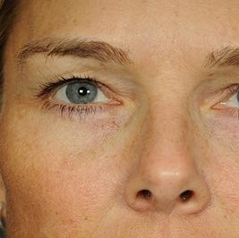 Ponytail Facelift before and after, case 60, view 8 (before)
