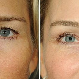 Ponytail Facelift before and after, case 60, view 8 (progress)