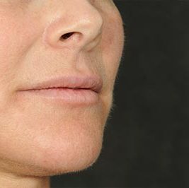 Ponytail Facelift before and after, case 60, view 9 (after)