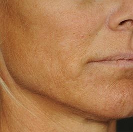 Ponytail Facelift before and after, case 60, view 9 (before)