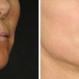 Ponytail Facelift before and after, case 60, view 9 (progress)