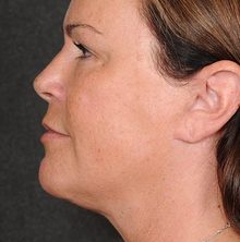 Ponytail Facelift before and after, case 61 (after)