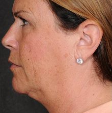 Ponytail Facelift before and after, case 61 (before)