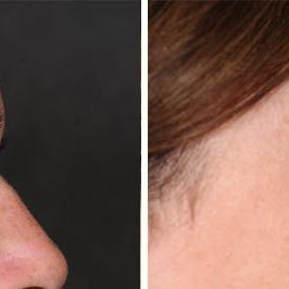 Ponytail Facelift before and after, case 61, view 2 (progress)