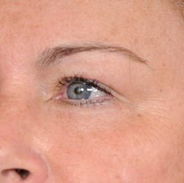 Ponytail Facelift before and after, case 61, view 3 (after)