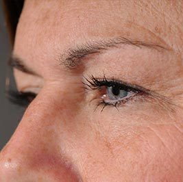 Ponytail Facelift before and after, case 61, view 3 (before)