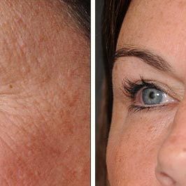 Ponytail Facelift before and after, case 61, view 3 (progress)