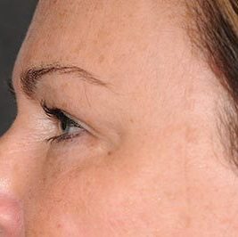 Ponytail Facelift before and after, case 61, view 4 (after)