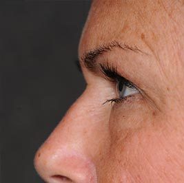 Ponytail Facelift before and after, case 61, view 4 (before)
