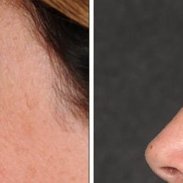 Ponytail Facelift before and after, case 61, view 4 (progress)
