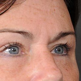 Ponytail Facelift before and after, case 61, view 5 (after)