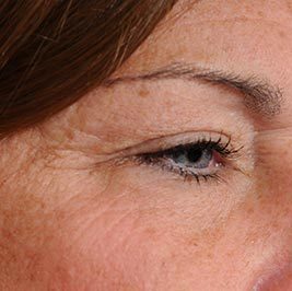 Ponytail Facelift before and after, case 61, view 5 (before)