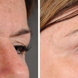 Ponytail Facelift before and after, case 61, view 5 (progress)
