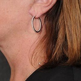 Ponytail Facelift before and after, case 61, view 6 (after)