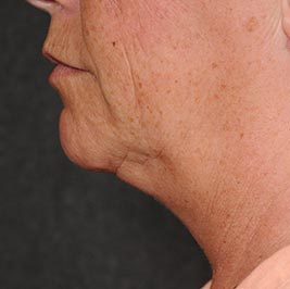 Ponytail Facelift before and after, case 61, view 6 (before)