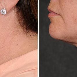 Ponytail Facelift before and after, case 61, view 6 (progress)