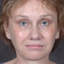 Ponytail Facelift before and after, case 62 (after)